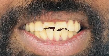 close-up of the fractured front tooth before treatment
